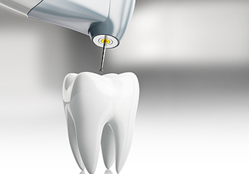 Root canal treatment in Doha, Qatar
